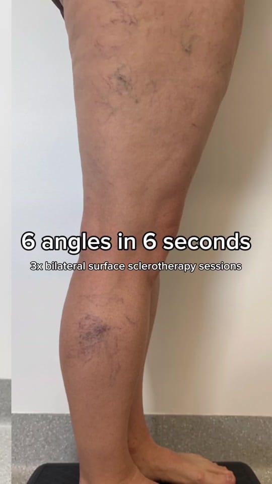 Post 1 by The Varicose Vein Clinic on TikTok (video)