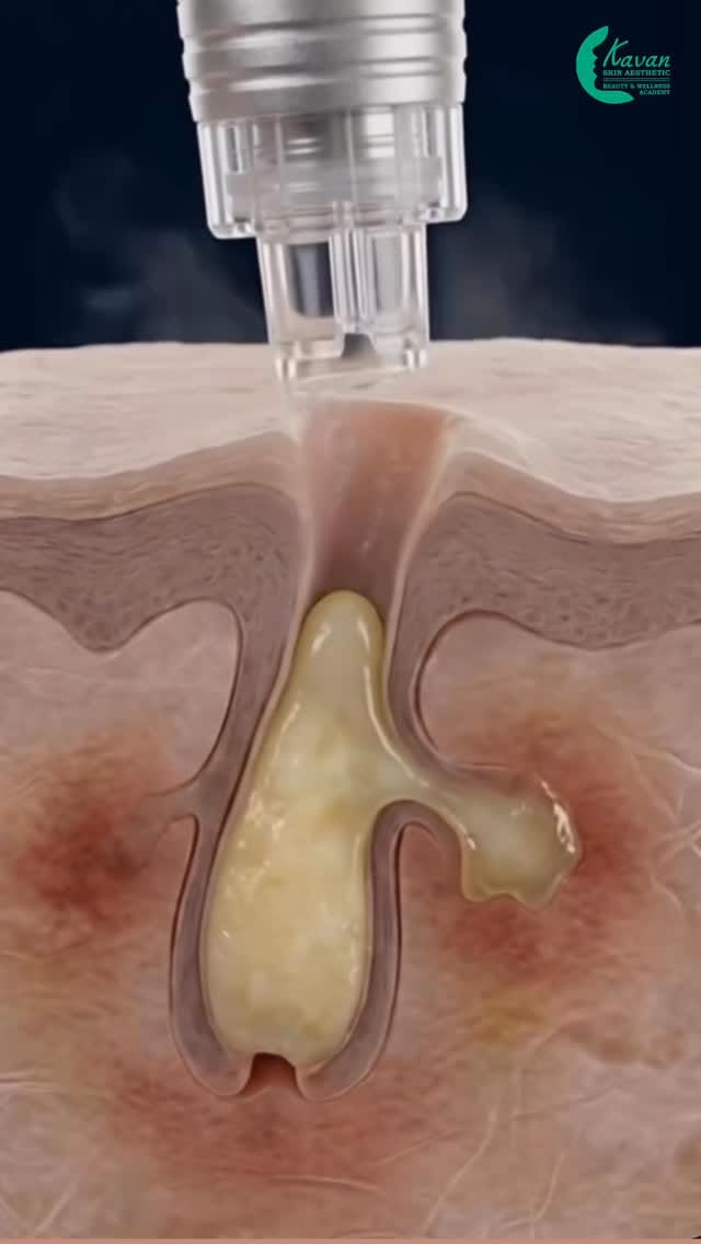 Post 4 by Kavan Skin Aesthetic | Beauty & Wellness Academy on Instagram (video)