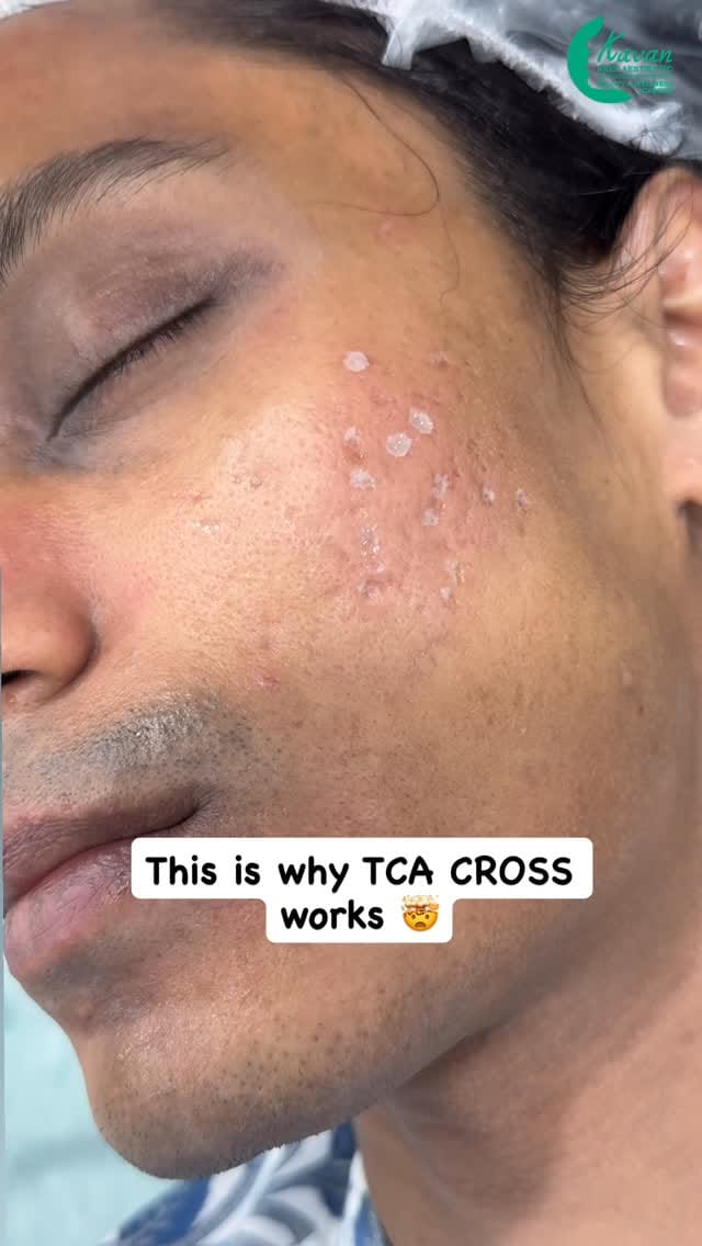Post 6 by Kavan Skin Aesthetic | Beauty & Wellness Academy on Instagram (video)