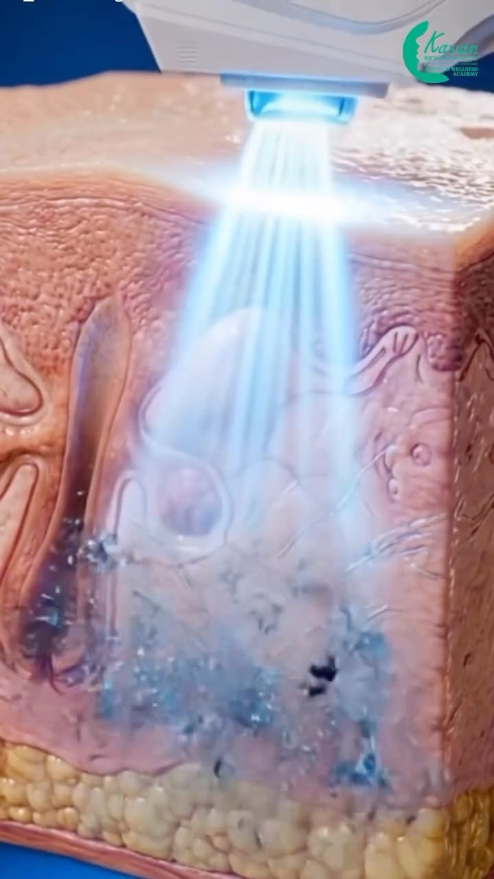 Post 5 by Kavan Skin Aesthetic | Beauty & Wellness Academy on Instagram (video)