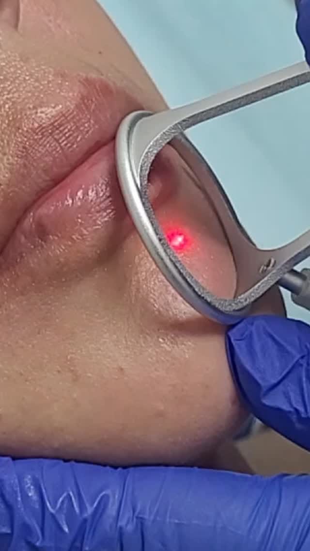 Post 10 by Vanitas | Cosmetic Surgery | Endaser + on Instagram (video)