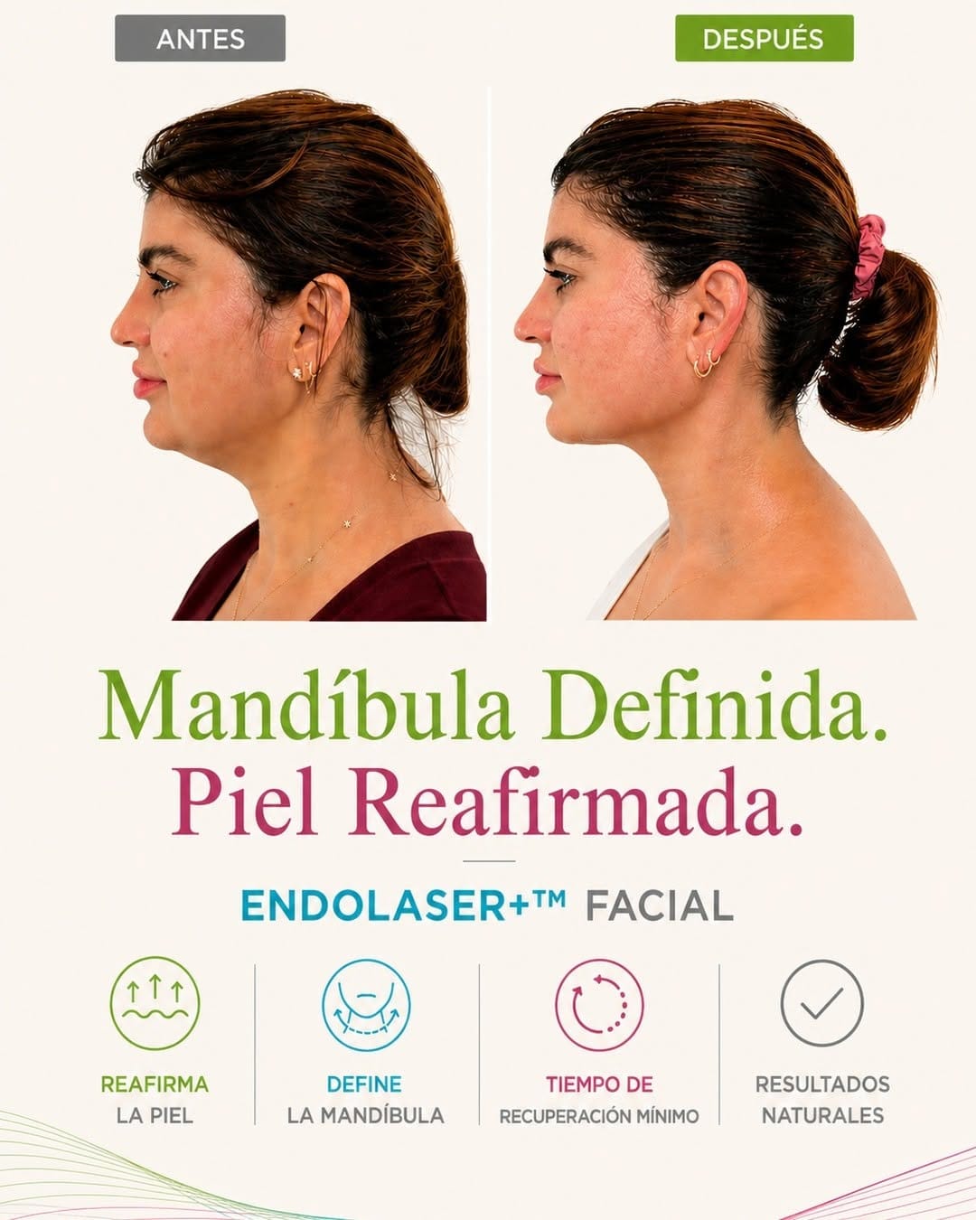 Post 8 by Vanitas | Cosmetic Surgery | Endaser + on Instagram (image)