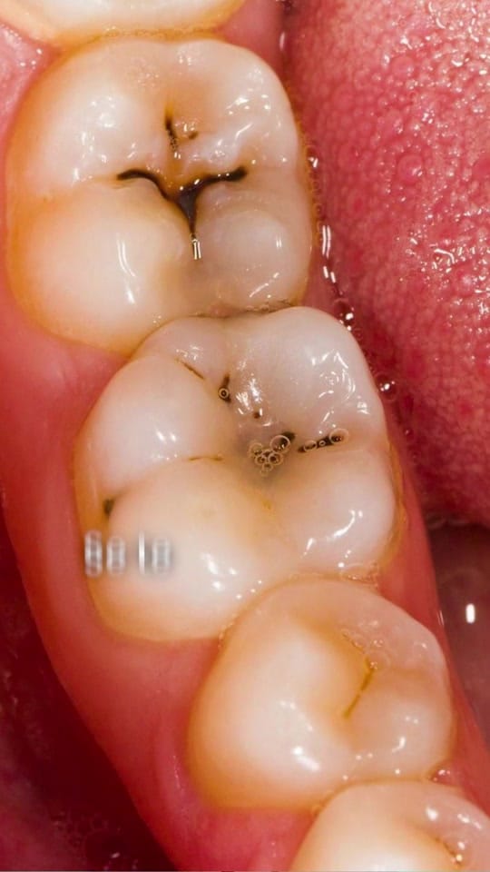 Post 5 by MKDental.mx on TikTok (video)