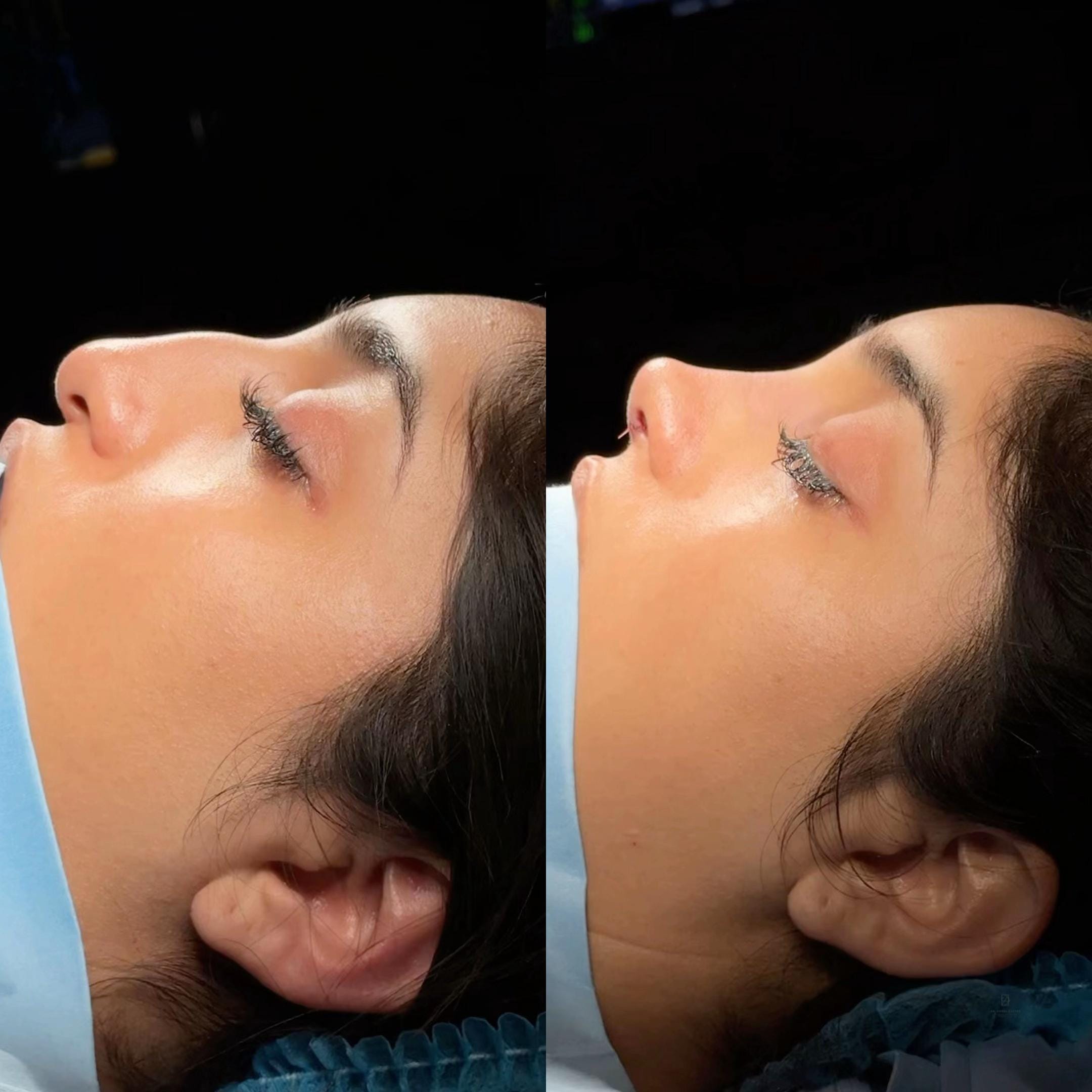 Post 5 by Dr. Angel Castro Rinoplastia on TikTok (video)