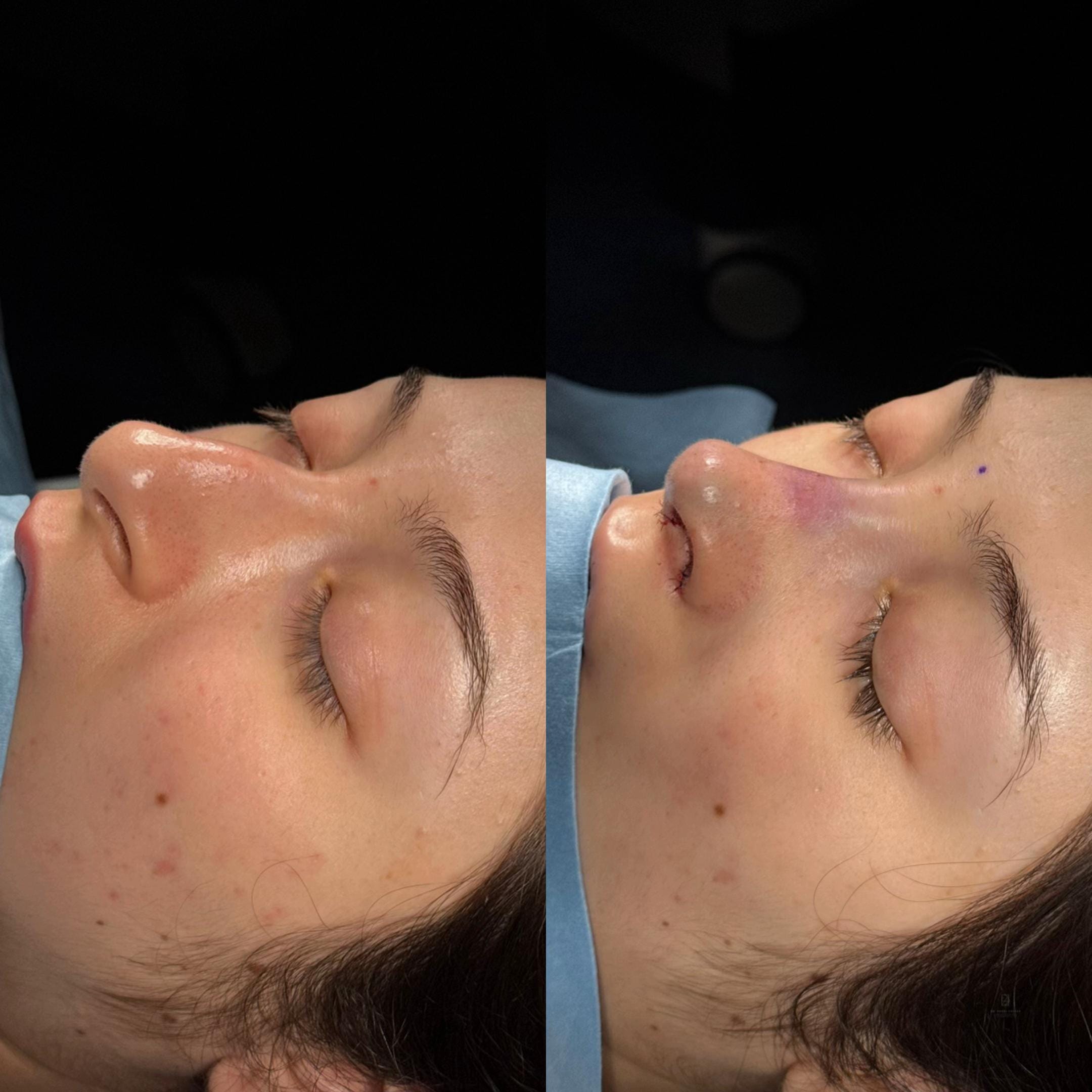 Post 7 by Dr. Angel Castro Rinoplastia on TikTok (video)