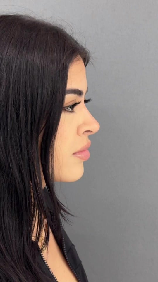 Post 6 by Dr. Angel Castro Rinoplastia on TikTok (video)