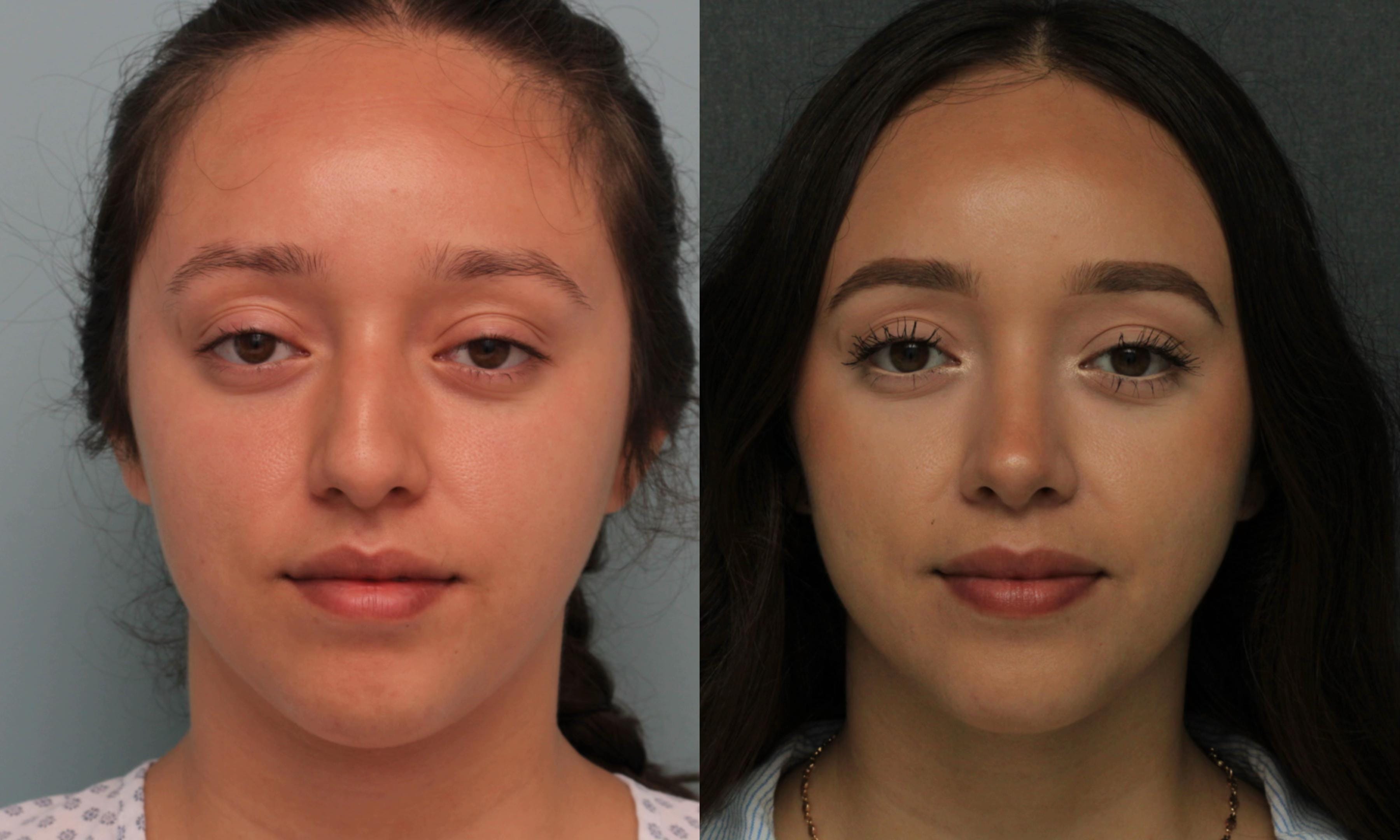 Post 3 by Dr. Angel Castro Rinoplastia on TikTok (video)