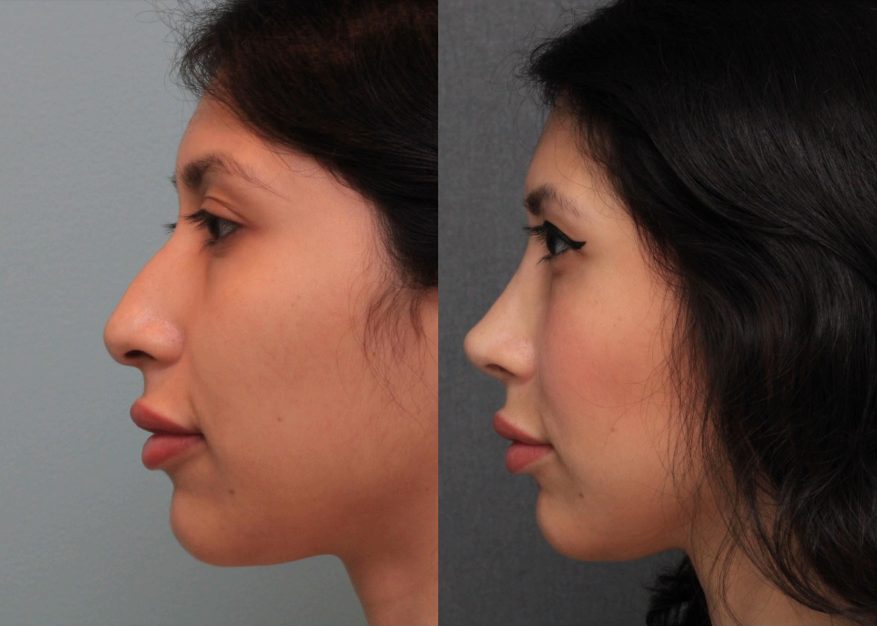 Post 10 by Dr. Angel Castro Rinoplastia on TikTok (video)