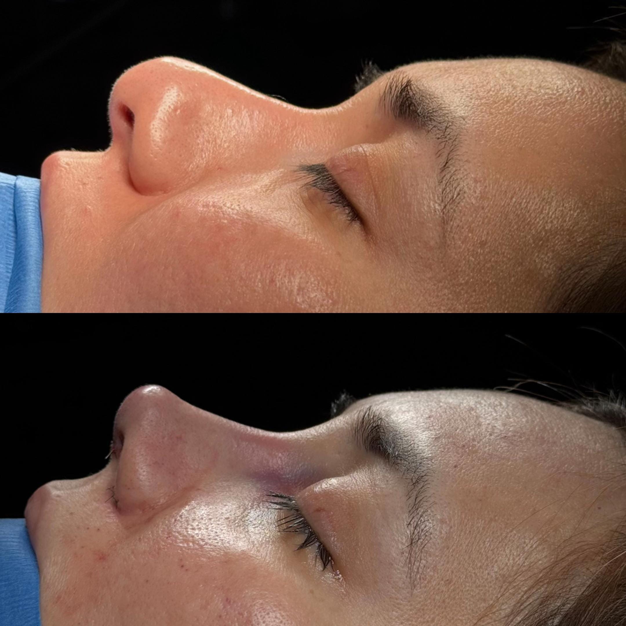 Post 2 by Dr. Angel Castro Rinoplastia on TikTok (video)