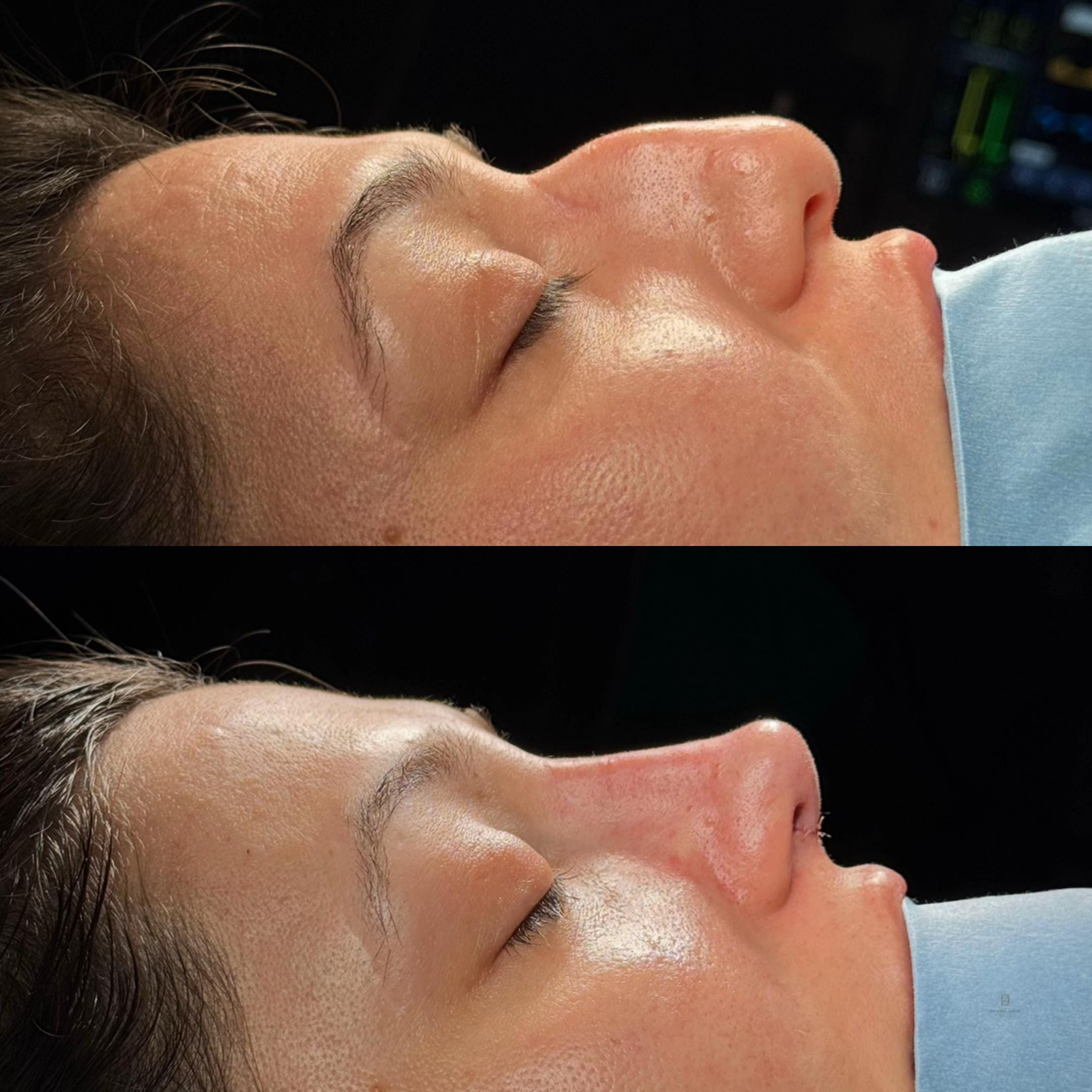 Post 1 by Dr. Angel Castro Rinoplastia on TikTok (video)