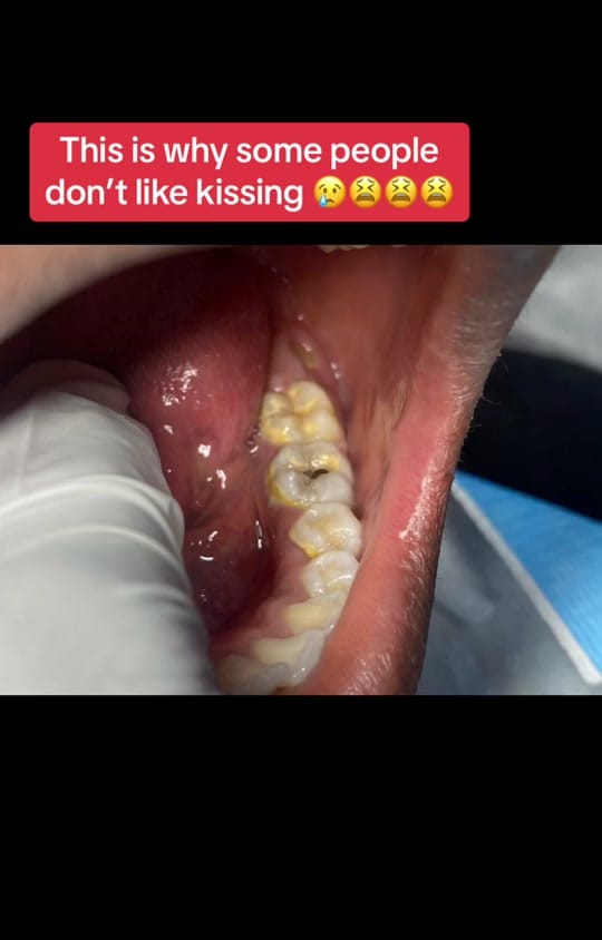 Post 9 by TEETH WHITENING PRO IN SANGO on TikTok (video)