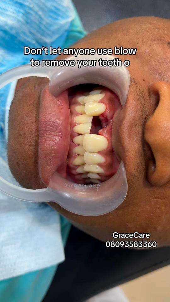 Post 7 by TEETH WHITENING PRO IN SANGO on TikTok (video)