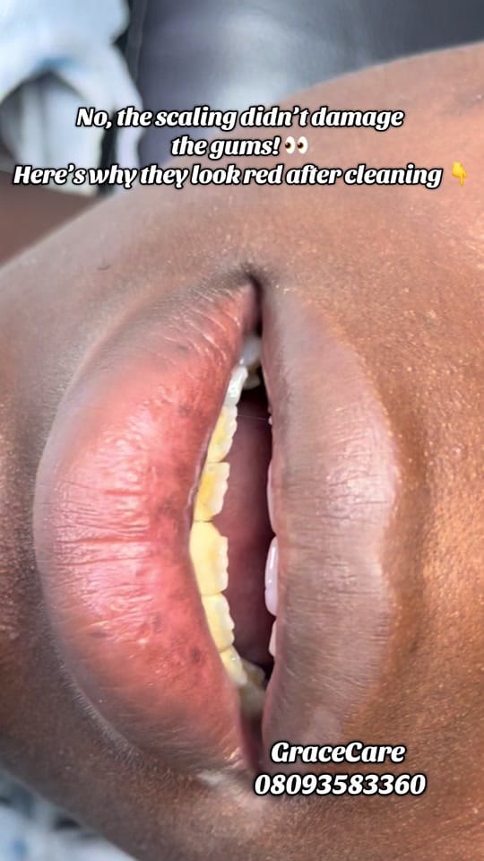 Post 5 by TEETH WHITENING PRO IN SANGO on TikTok (video)