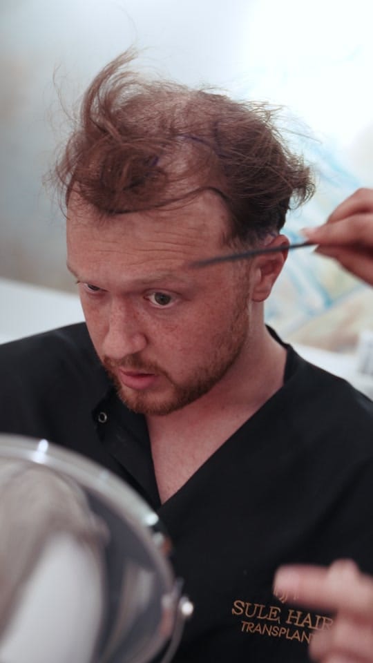 Post 7 by Sule Hair Transplant on TikTok (video)