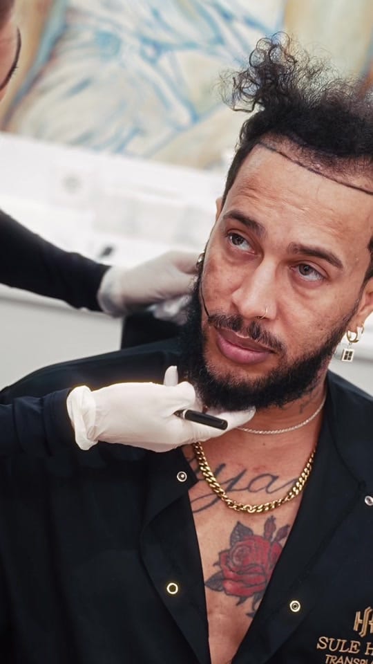 Post 9 by Sule Hair Transplant on TikTok (video)