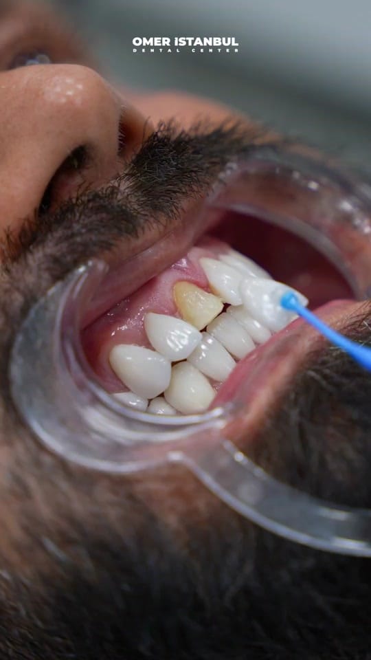 Post 9 by Omer Istanbul Dental Clinic on TikTok (video)