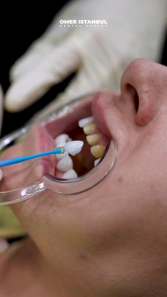 Post 8 by Omer Istanbul Dental Clinic on TikTok (video)