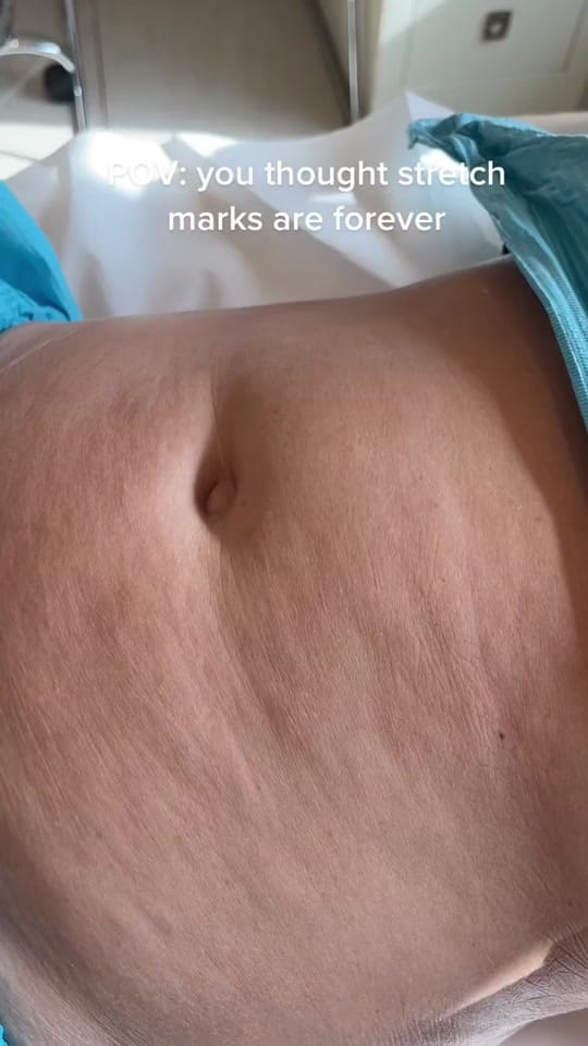 Post 3 by Doctor | Skin | Laser | Dubai on TikTok (video)