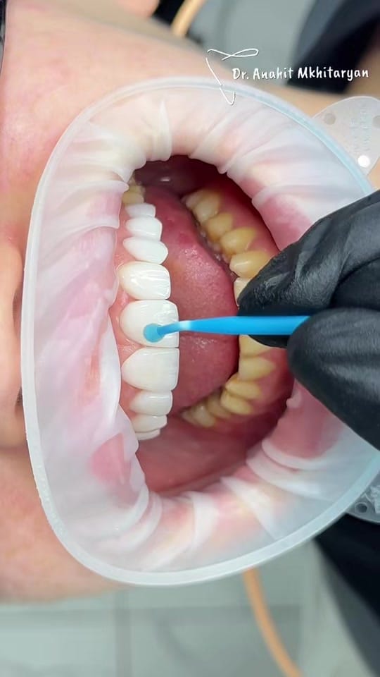 Post 4 by dentist_dubaiANAHIT on TikTok (video)
