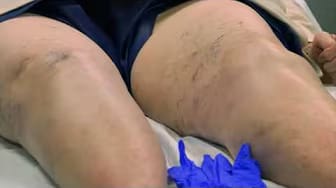 Post 1 by Advanced Vein Care - David C. Faber, MD, FACS on YouTube (video)