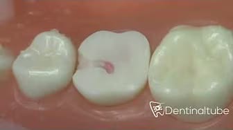 Post 10 by Dentinaltube Channel on YouTube (video)