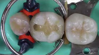 Post 6 by Dentinaltube Channel on YouTube (video)