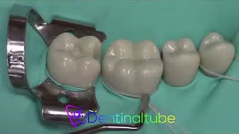 Post 5 by Dentinaltube Channel on YouTube (video)