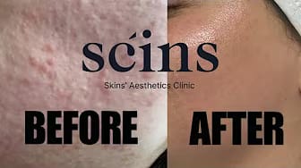 Post 4 by Scins on YouTube (video)