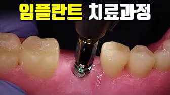 Post 7 by 빈치의 치과치료 과정 on YouTube (video)