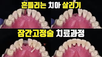 Post 3 by 빈치의 치과치료 과정 on YouTube (video)