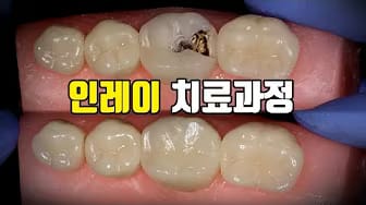 Post 2 by 빈치의 치과치료 과정 on YouTube (video)