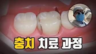 Post 1 by 빈치의 치과치료 과정 on YouTube (video)