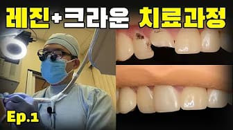 Post 6 by 빈치의 치과치료 과정 on YouTube (video)