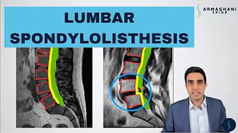 Post 5 by Armaghani Spine on YouTube (video)