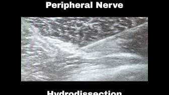 Post 5 by Dr. Markle: Regenerative Orthopedics Expert on YouTube (video)