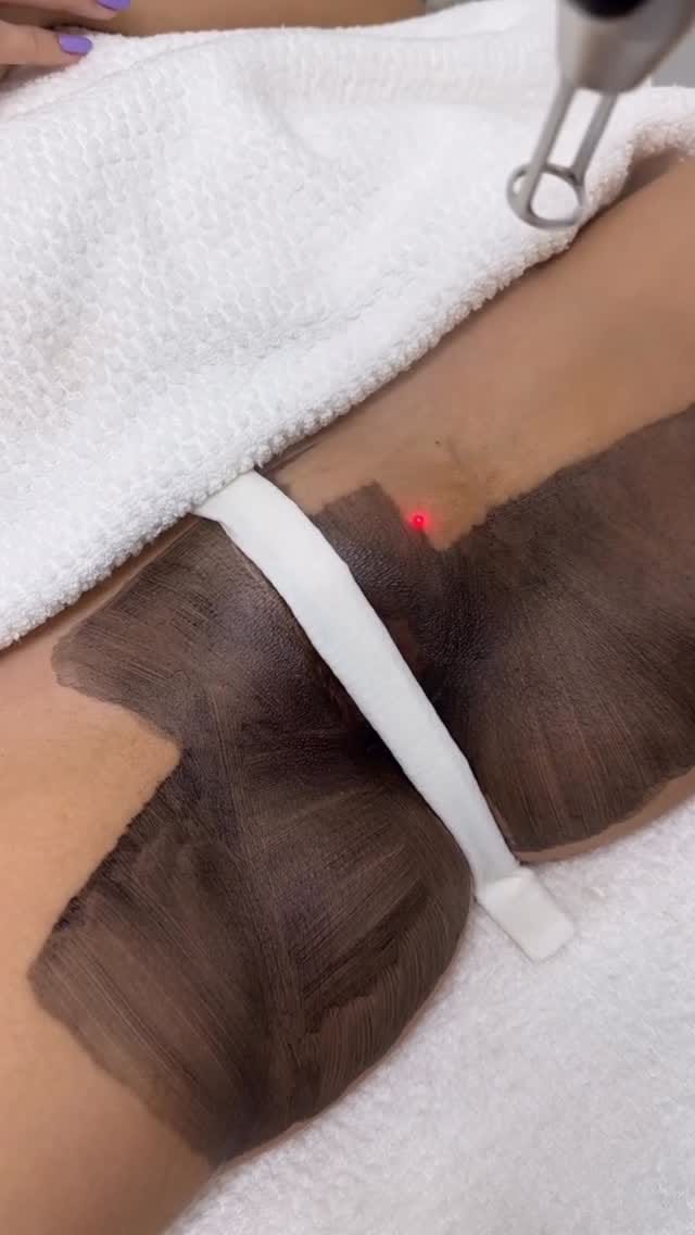Post 8 by Alexander Medina | Depilación Láser & Estética on Instagram (video)