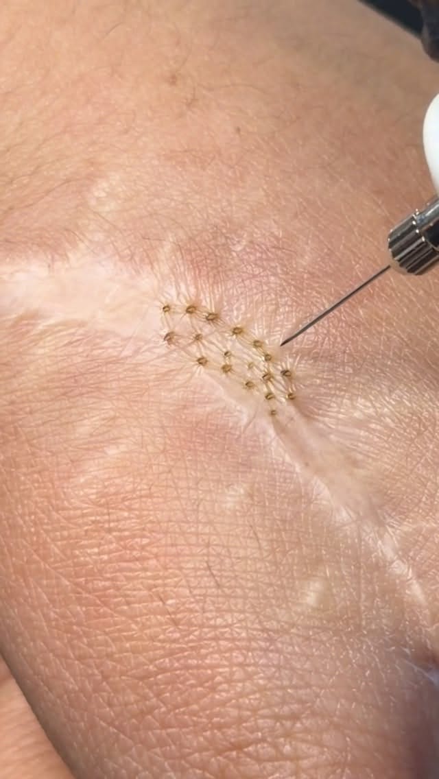 Post 9 by Alexander Medina | Depilación Láser & Estética on Instagram (video)