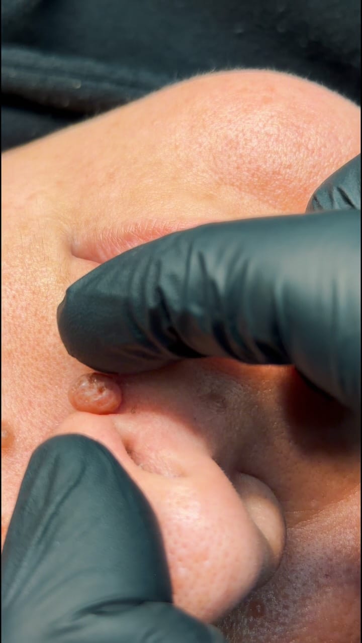 Post 5 by Alexander Medina | Depilación Láser & Estética on Instagram (video)