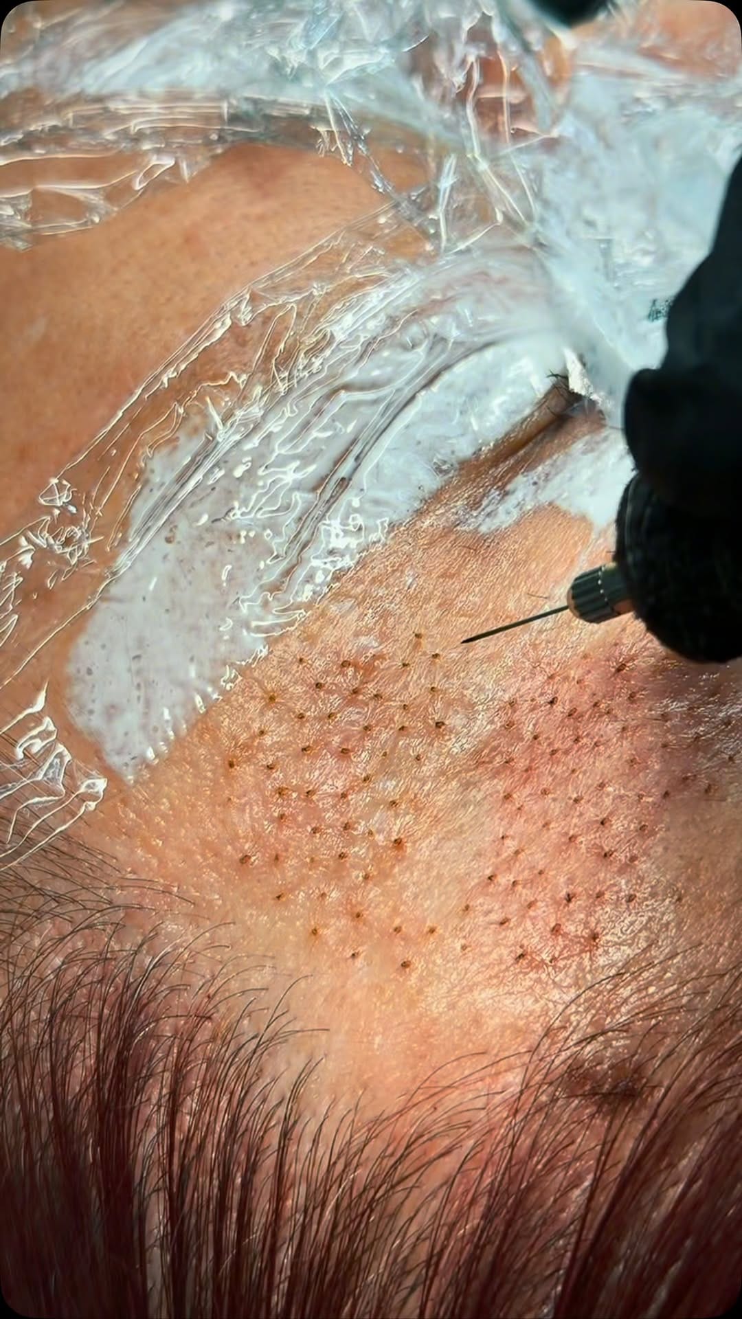 Post 2 by Alexander Medina | Depilación Láser & Estética on Instagram (video)