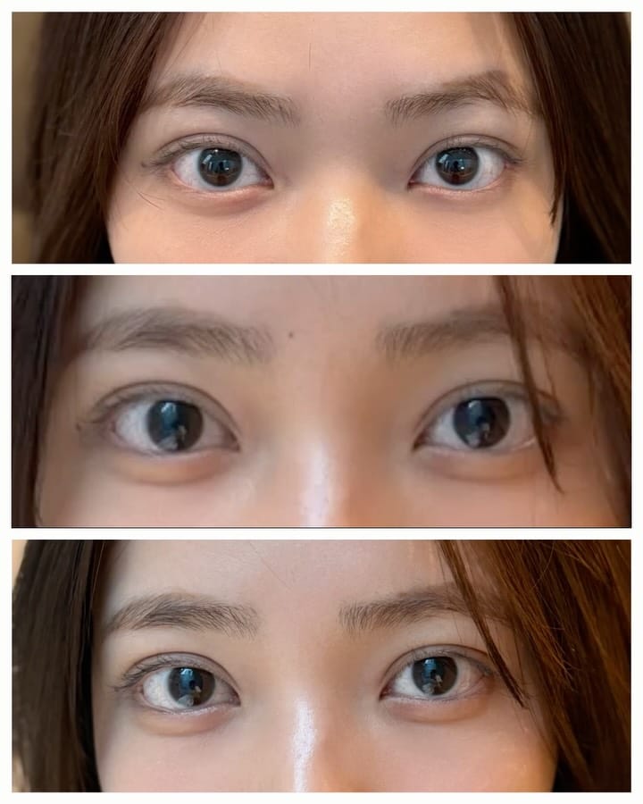 Post 5 by yuzawa clinic 代表 湯澤勇典 二重整形/埋没法/目頭切開 on Instagram (carousel)