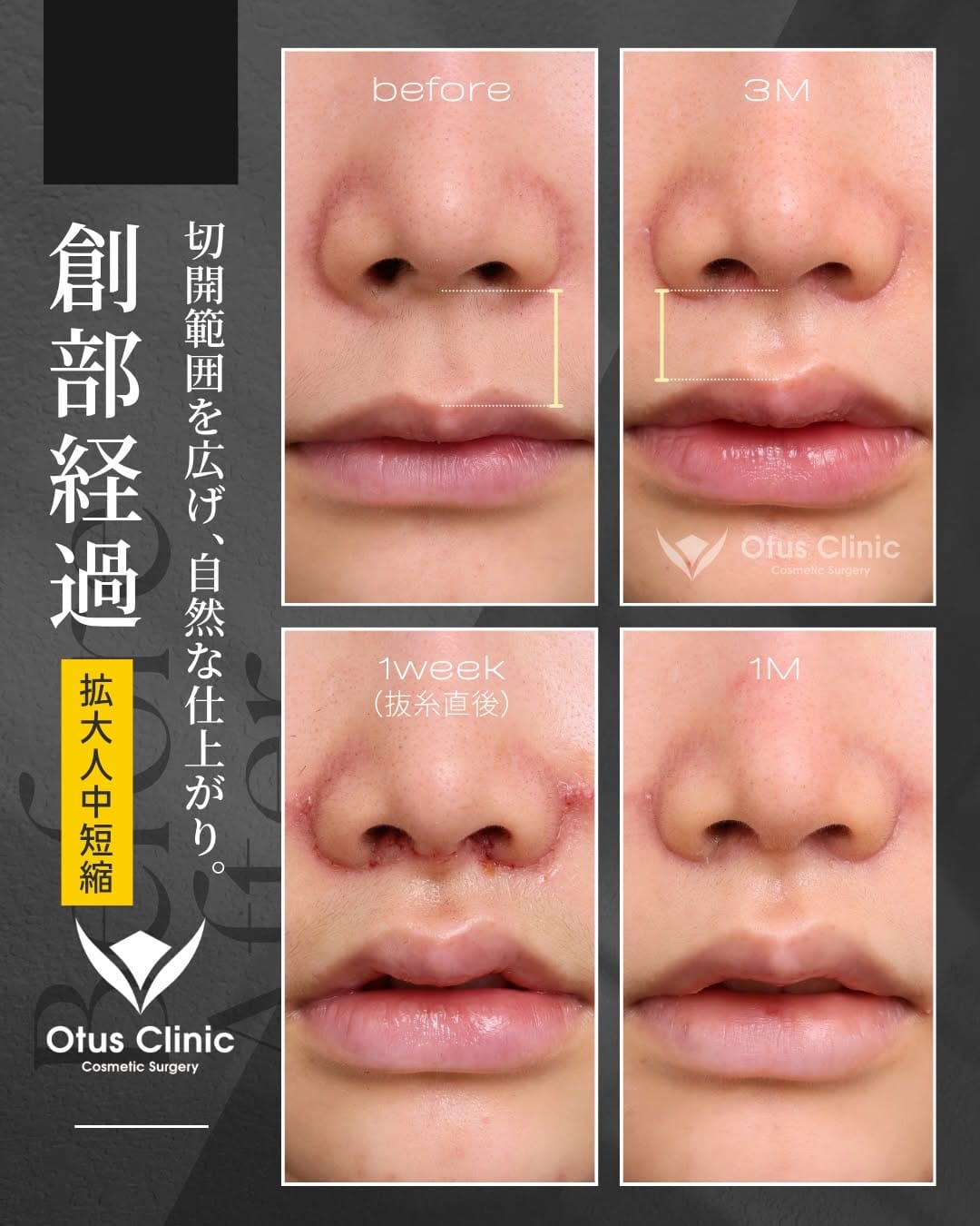 Post 2 by Otus Clinic｜オータスクリニック on Instagram (carousel)