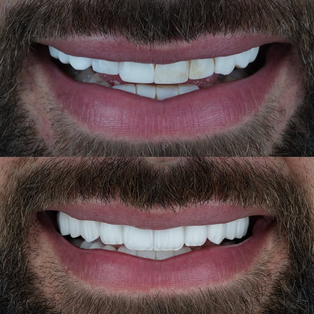 Post 6 by 𝘿𝙧. 𝙃𝙚𝙡𝙖 𝙍𝙖𝙠𝙮 🦷 د. هيلـه راقـي on Instagram (carousel)