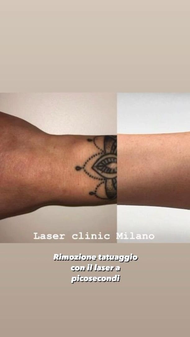 Post 9 by LASER CLINIC MILANO | Chirurgia Plastica | Rimozione tatuaggi on Instagram (video)