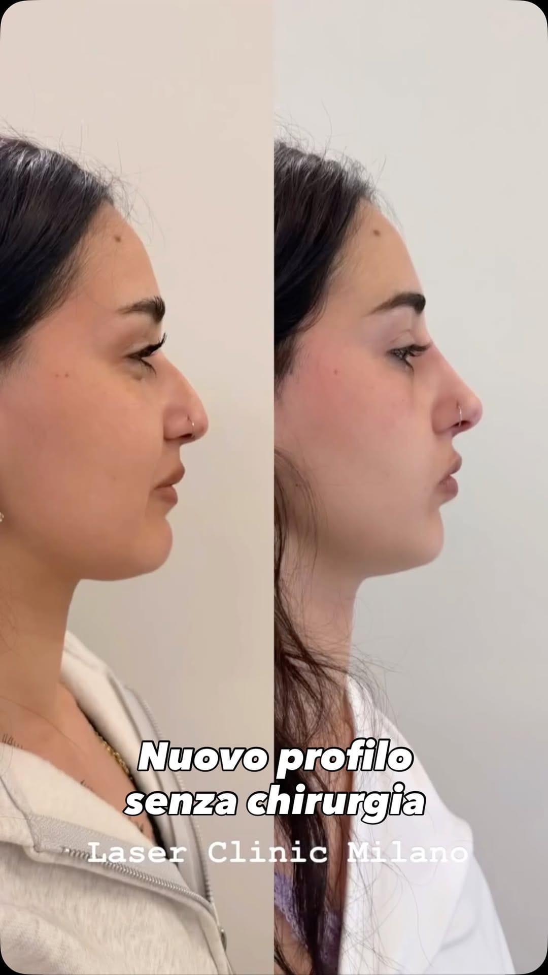 Post 6 by LASER CLINIC MILANO | Chirurgia Plastica | Rimozione tatuaggi on Instagram (video)