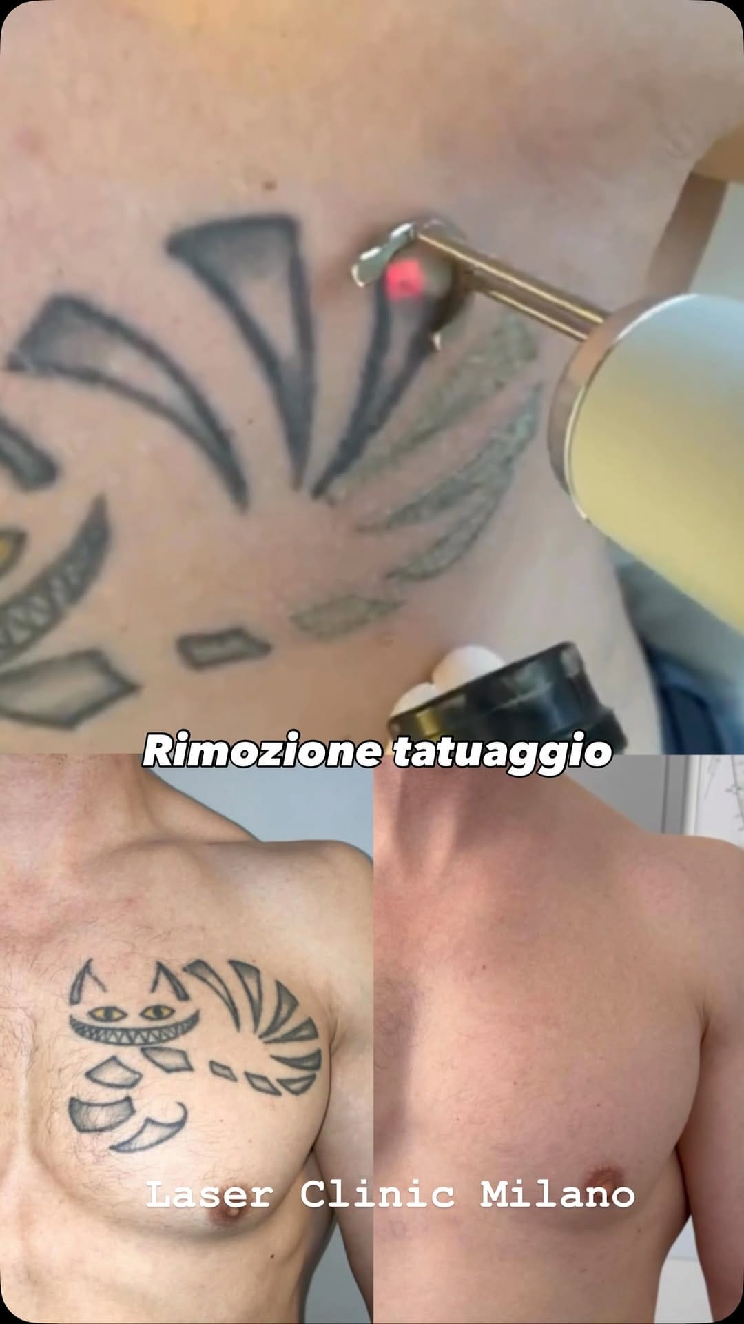 Post 1 by LASER CLINIC MILANO | Chirurgia Plastica | Rimozione tatuaggi on Instagram (video)