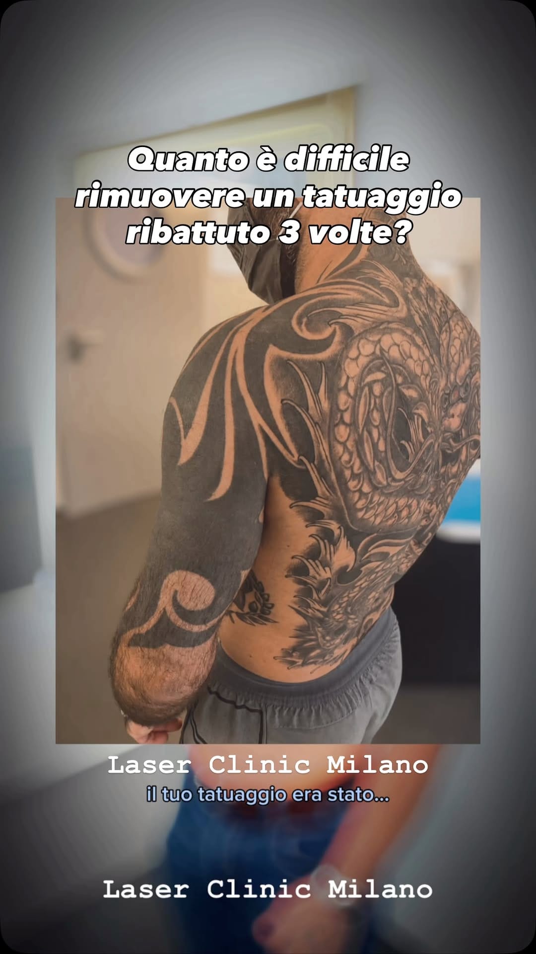 Post 2 by LASER CLINIC MILANO | Chirurgia Plastica | Rimozione tatuaggi on Instagram (video)