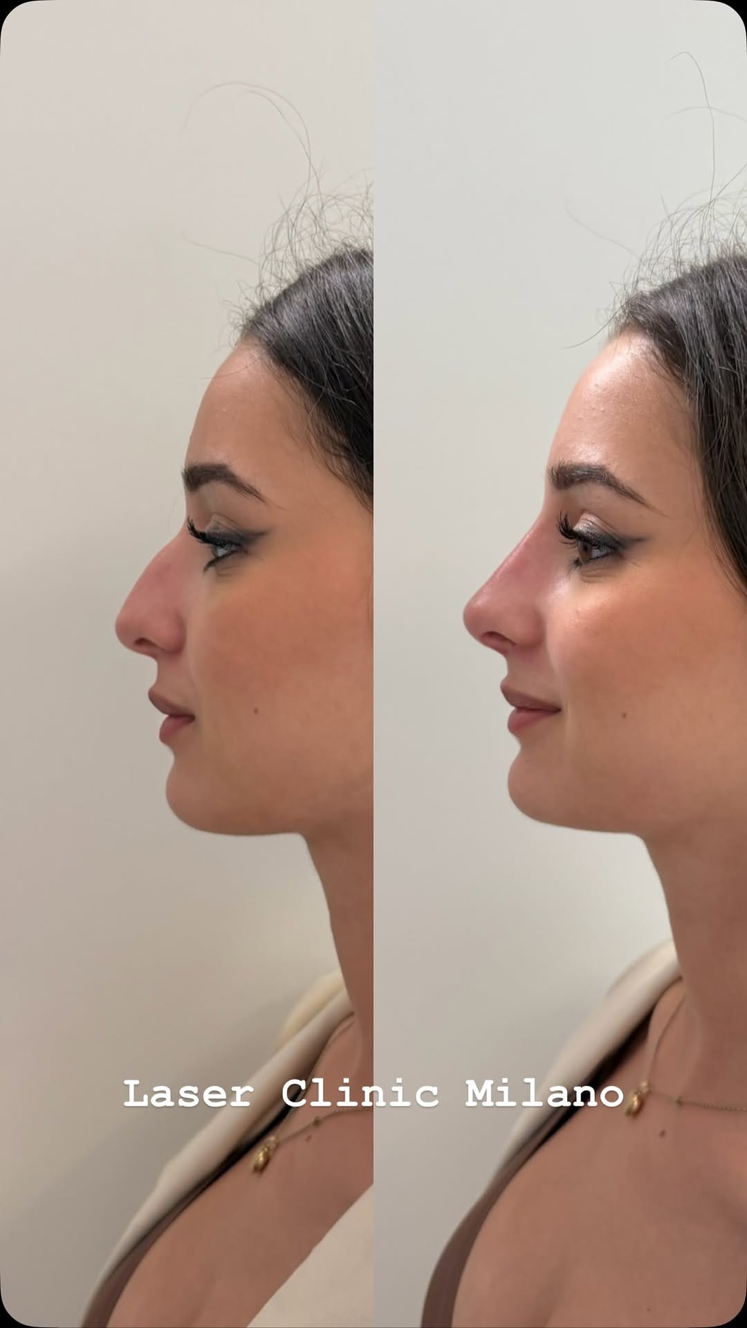 Post 4 by LASER CLINIC MILANO | Chirurgia Plastica | Rimozione tatuaggi on Instagram (video)