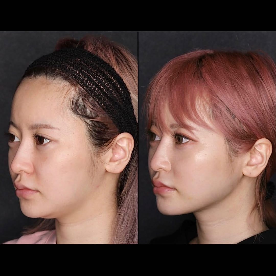 Post 9 by 【絶対美感】 前田 進太郎（眼瞼下垂/脂肪吸引/豊胸） on Instagram (carousel)