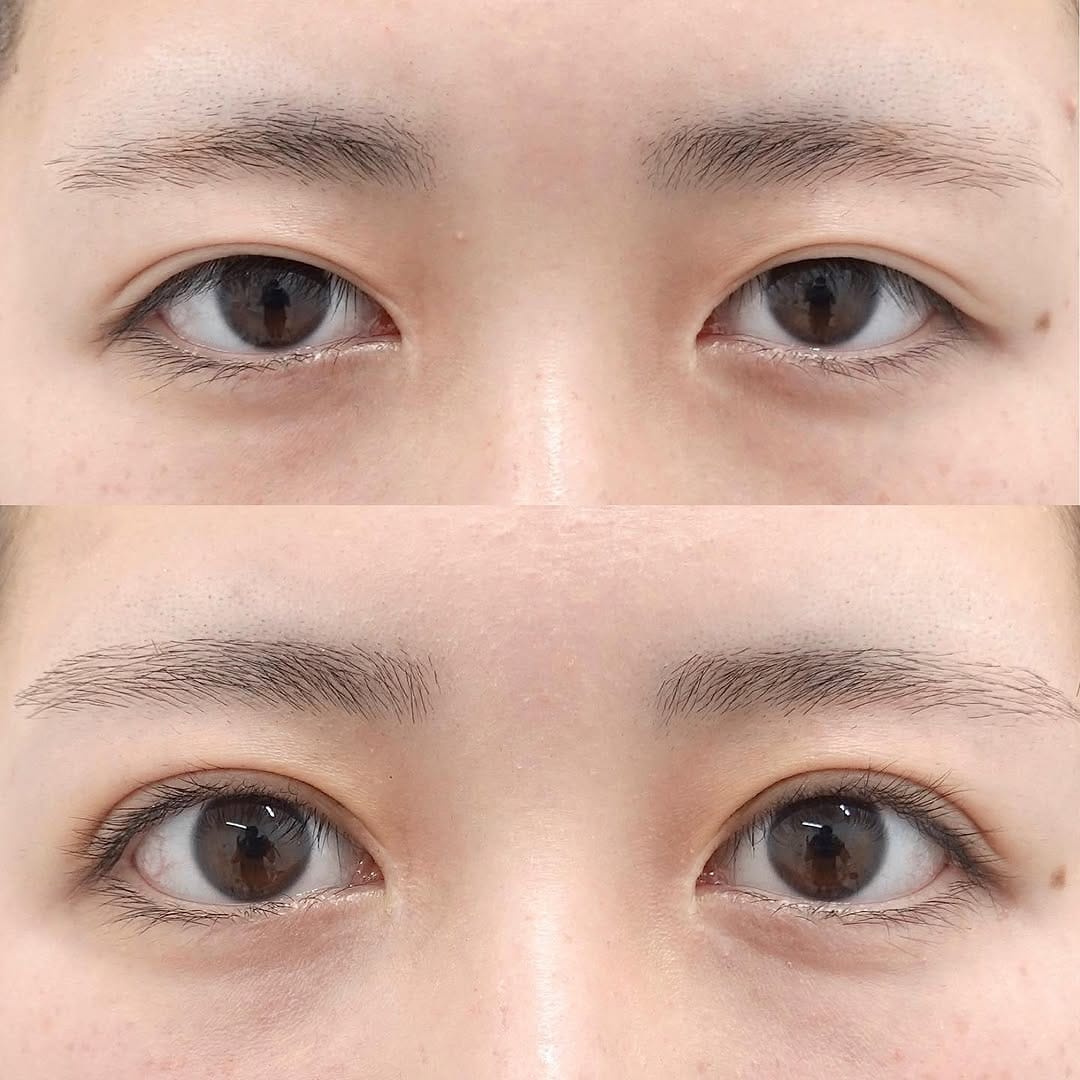 Post 8 by 【絶対美感】 前田 進太郎（眼瞼下垂/脂肪吸引/豊胸） on Instagram (carousel)