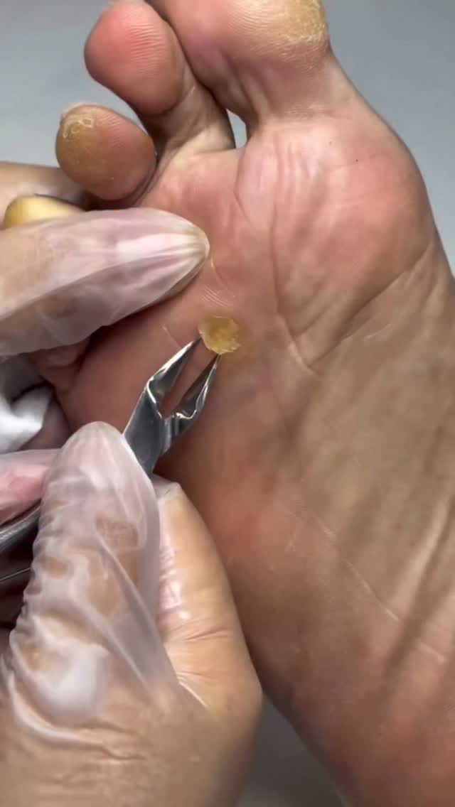 Post 7 by HALINA THE CUPPING CLINIC on Instagram (video)